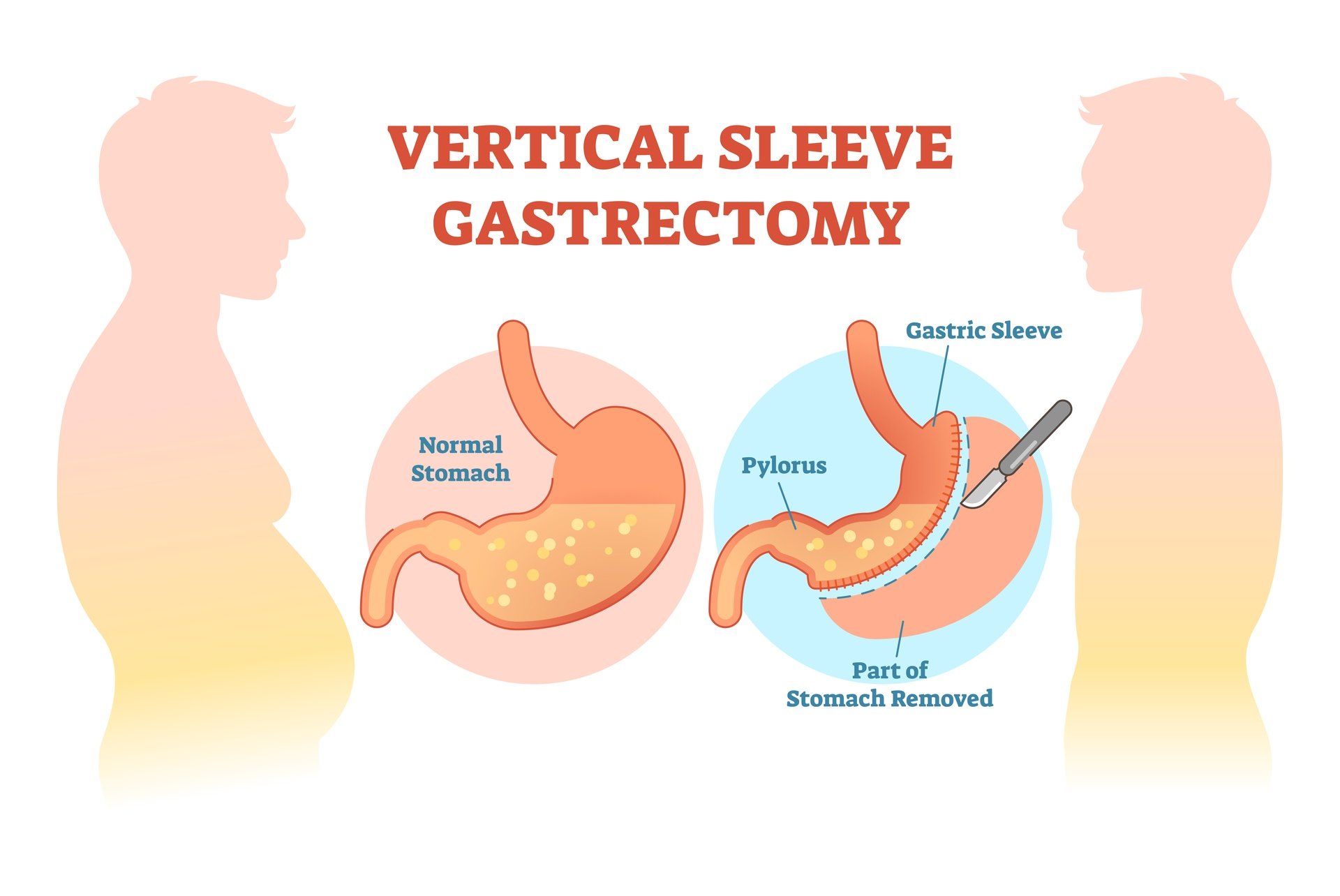 Lose Weight Fast With Gastric Sleeve Surgery Birmingham Minimally 