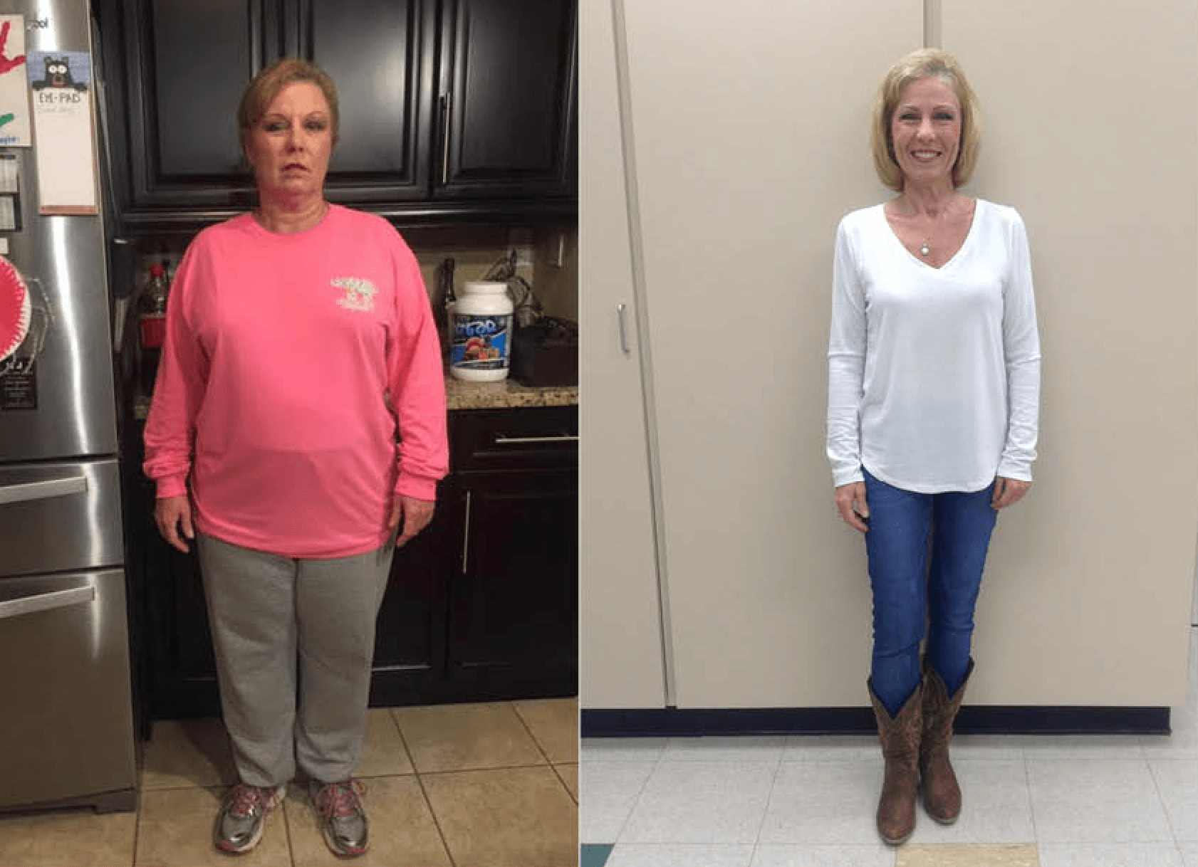Gastric Sleeve Surgery Before And After Pictures Gastric Sleeve