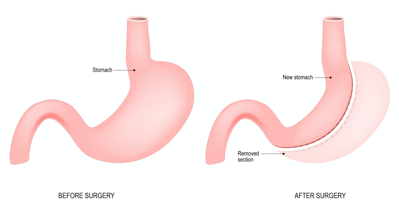 Gastric Sleeve Surgery What You Need To Know