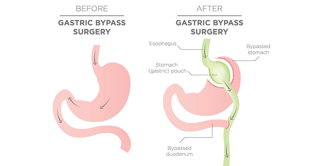 Weight Loss After Gastric Sleeve: How to Restart Post Surgery?
