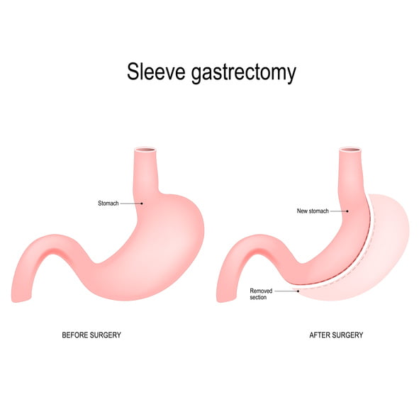 Explaining The “sleeve” In Gastric Sleeve Surgery Birmingham