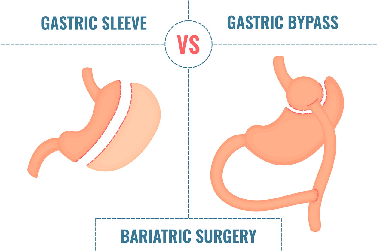 Laparoscopic Gastric Bypass 101 Answering Your Top 5 Questions