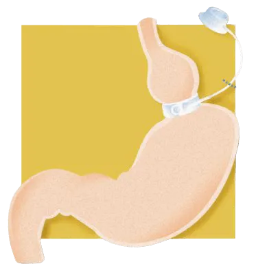 Illustration of stomach with adjustable gastric (lap) band and access port for bariatric surgery