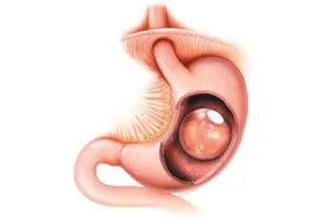 Stomach cross-section medical illustration showing intragastric balloon for bariatric weight-loss treatment