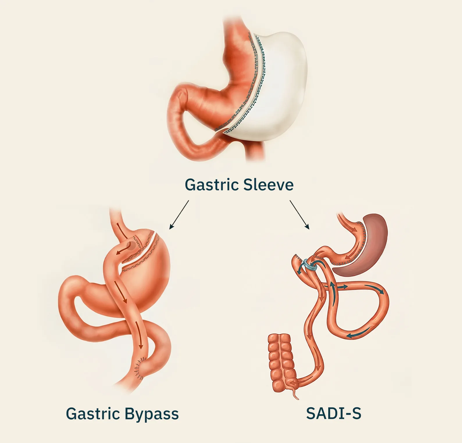 Diagram of bariatric surgery techniques: gastric sleeve, gastric bypass, and SADI-S with stapled stomach illustrations